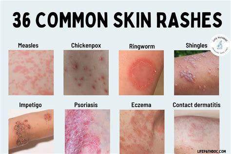 ang sakit sa dibdib in english|7 Common Types of Skin Rashes in the Philippines .